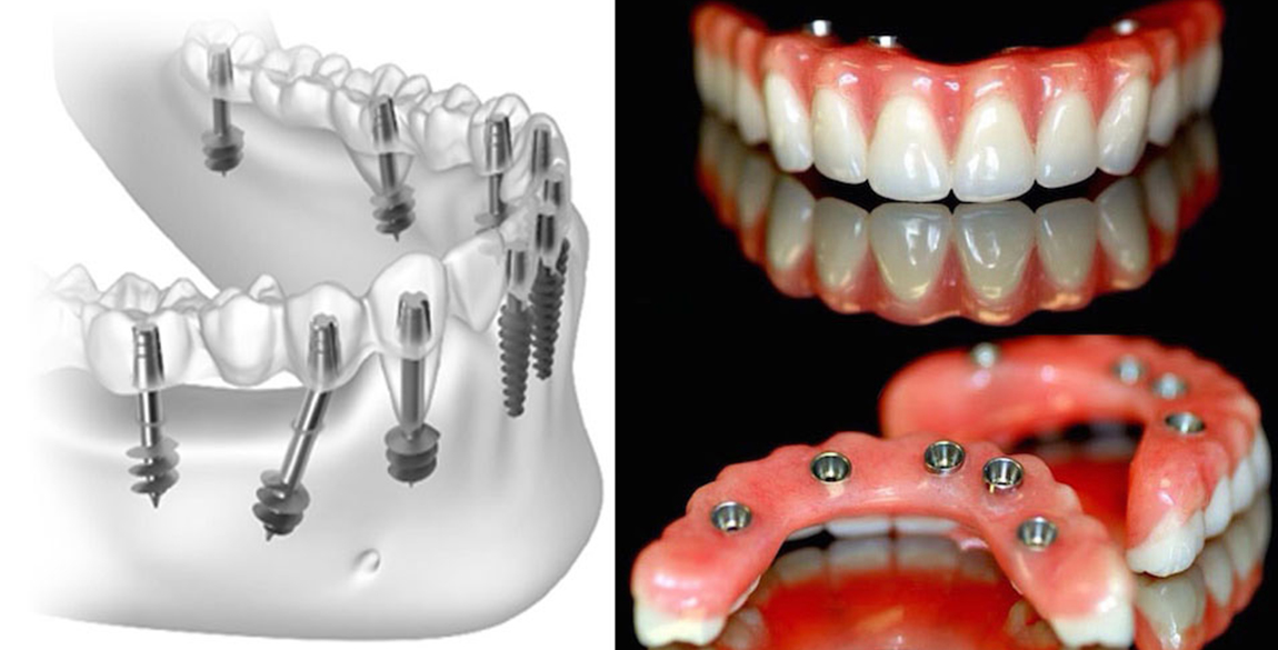 How Saliva Composition Analysis Predicts Dental Implant Success Rates